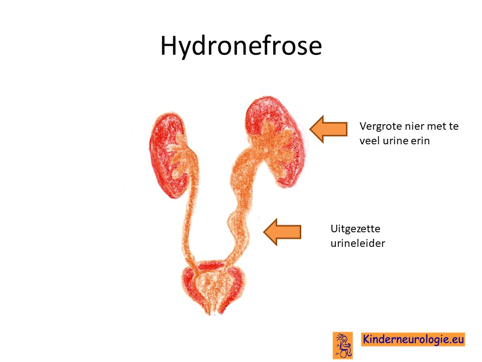 hydronefrose